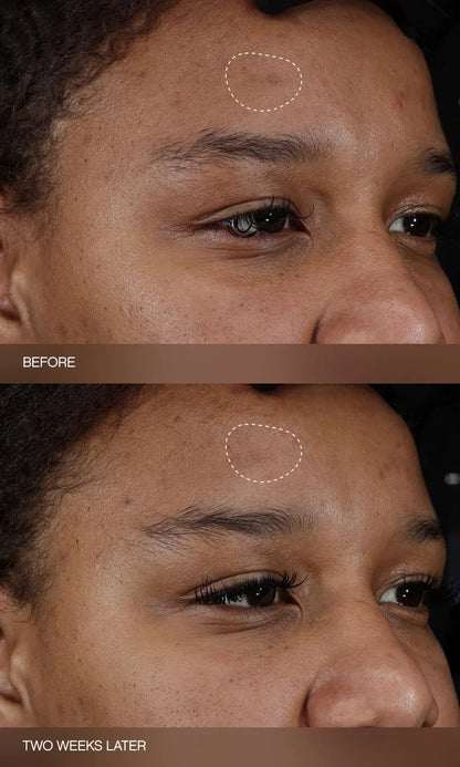 Faded Dark Spot Patches