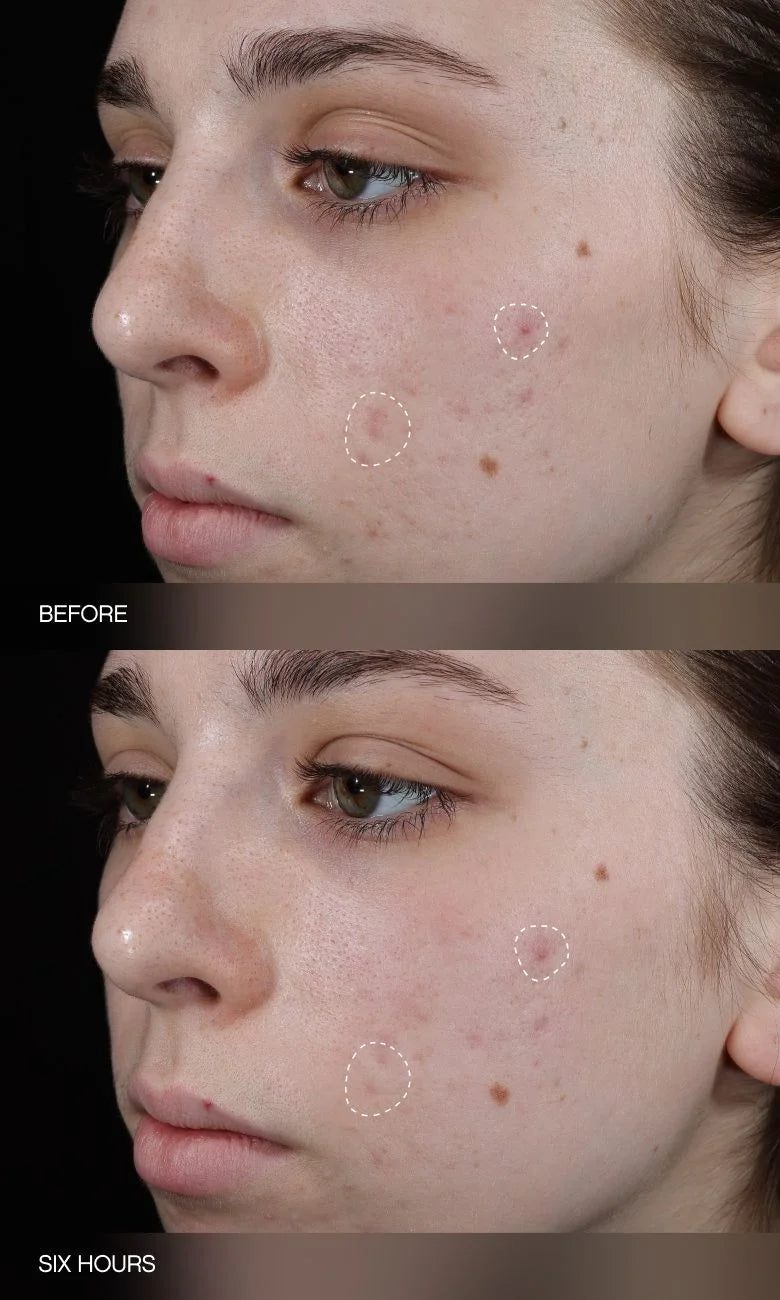 Faded Dark Spot Patches