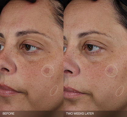 Faded Dark Spot Patches