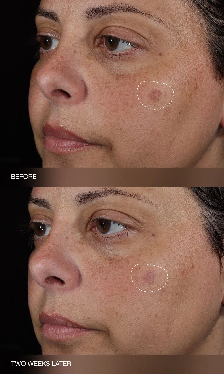 Faded Dark Spot Patches