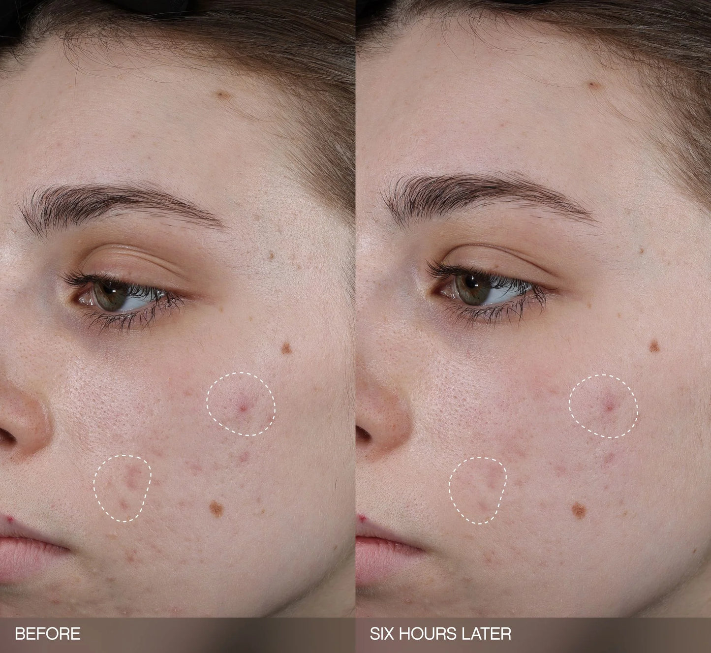 Faded Dark Spot Patches
