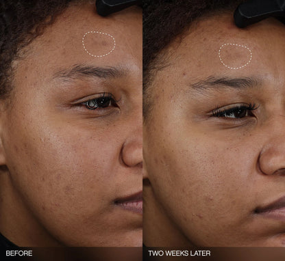 Faded Dark Spot Patches